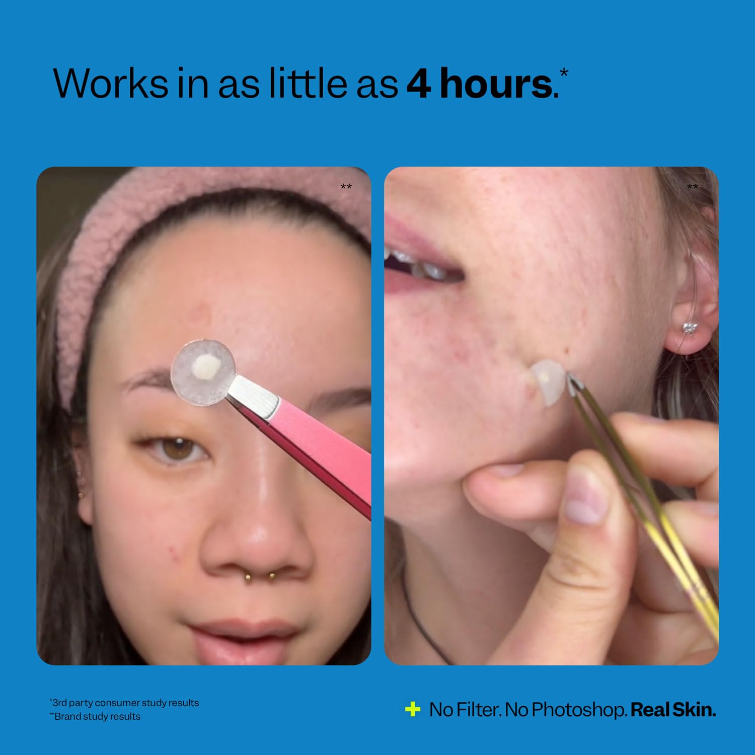 Peach Slices hydrocolloid patches absorbing gunk from blemish.