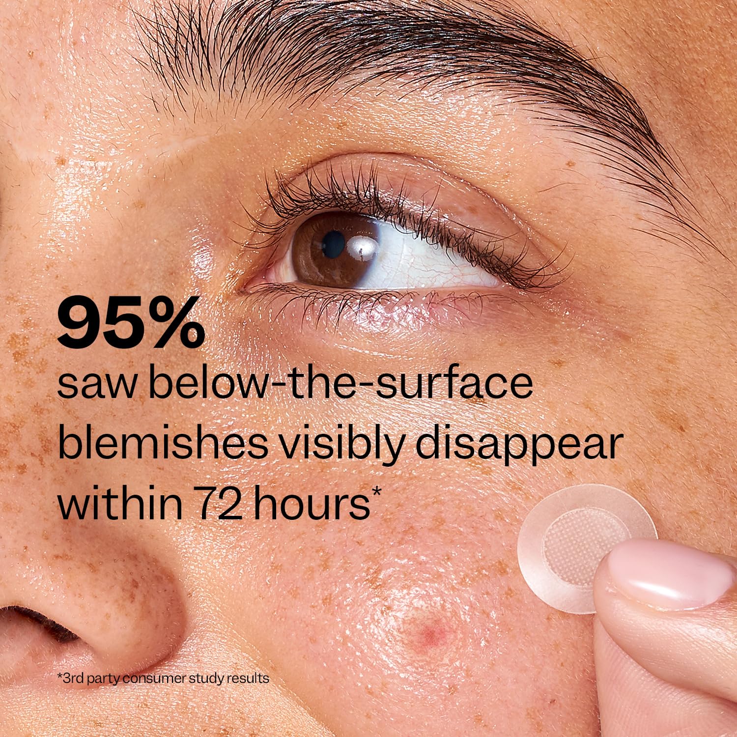 Peach Slices patch applied on the face for convenient blemish management.