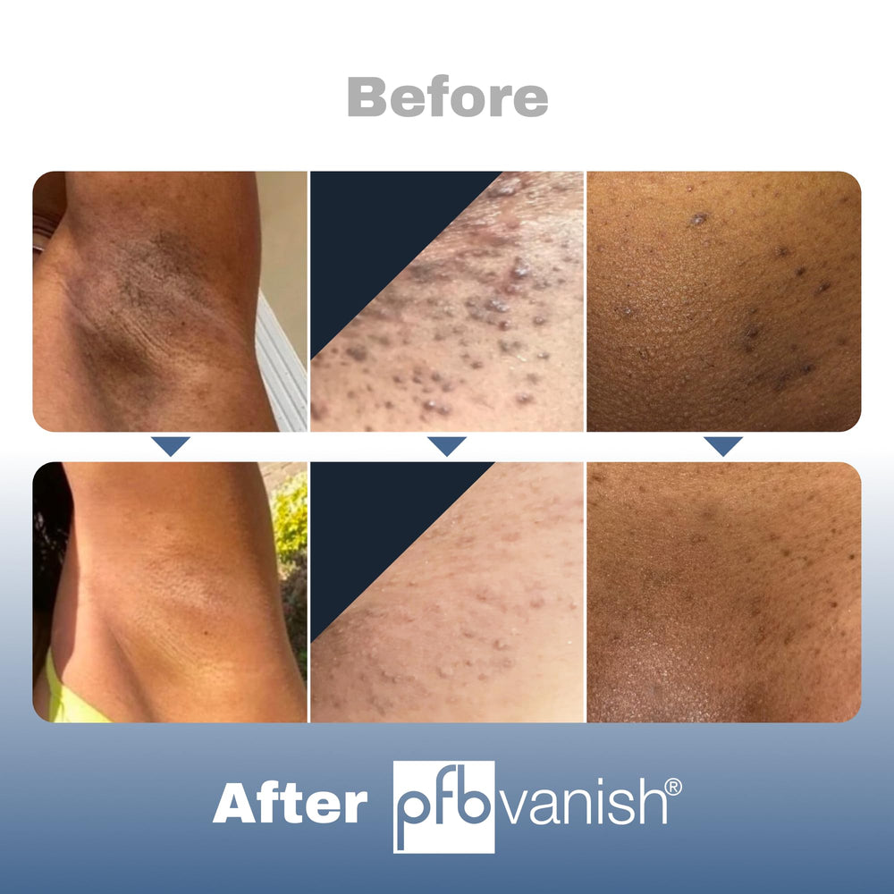 PFB Vanish razor burn relief on skin after shaving