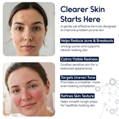 Pharmlitalia Azelaic Acid 15 bottle suggesting redness relief potential