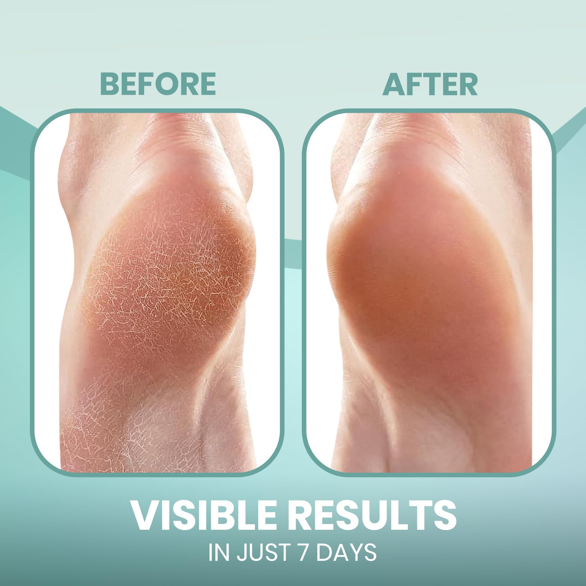 PhysFlex Moisturizing Socks worn overnight on foot for comfort