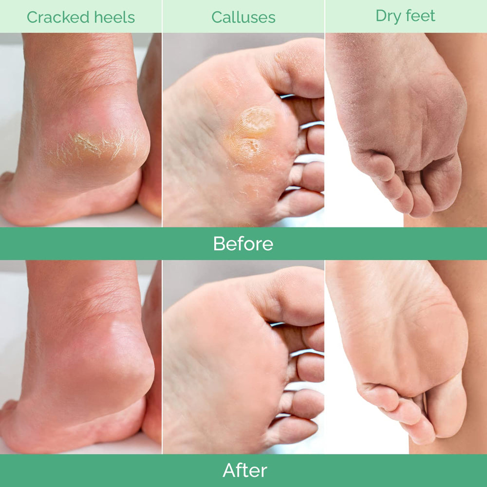 PLANTIFIQUE proceso de exfoliación en pies, piel muerta se desprende