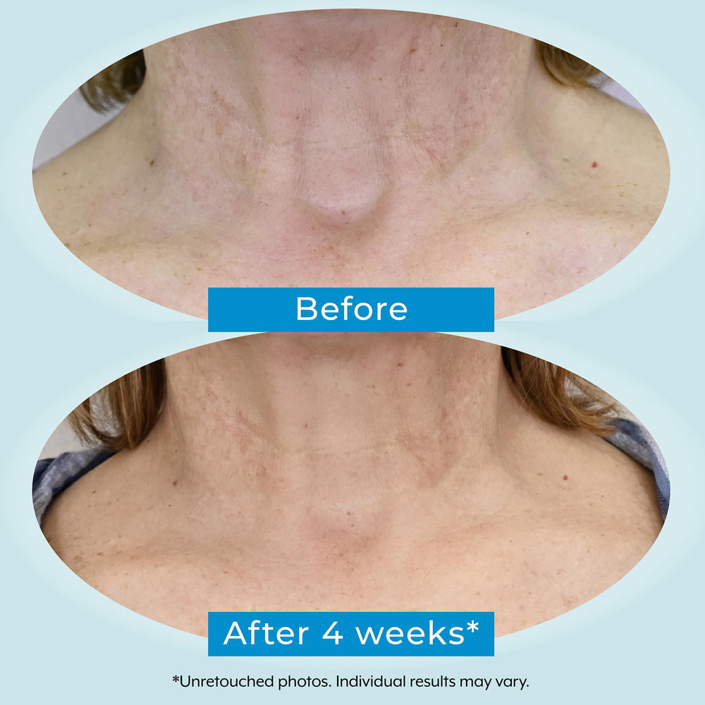 Plexaderm hyaluronic acid close-up emphasizing moisture retention for the neck.