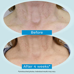 Plexaderm hyaluronic acid close-up emphasizing moisture retention for the neck.