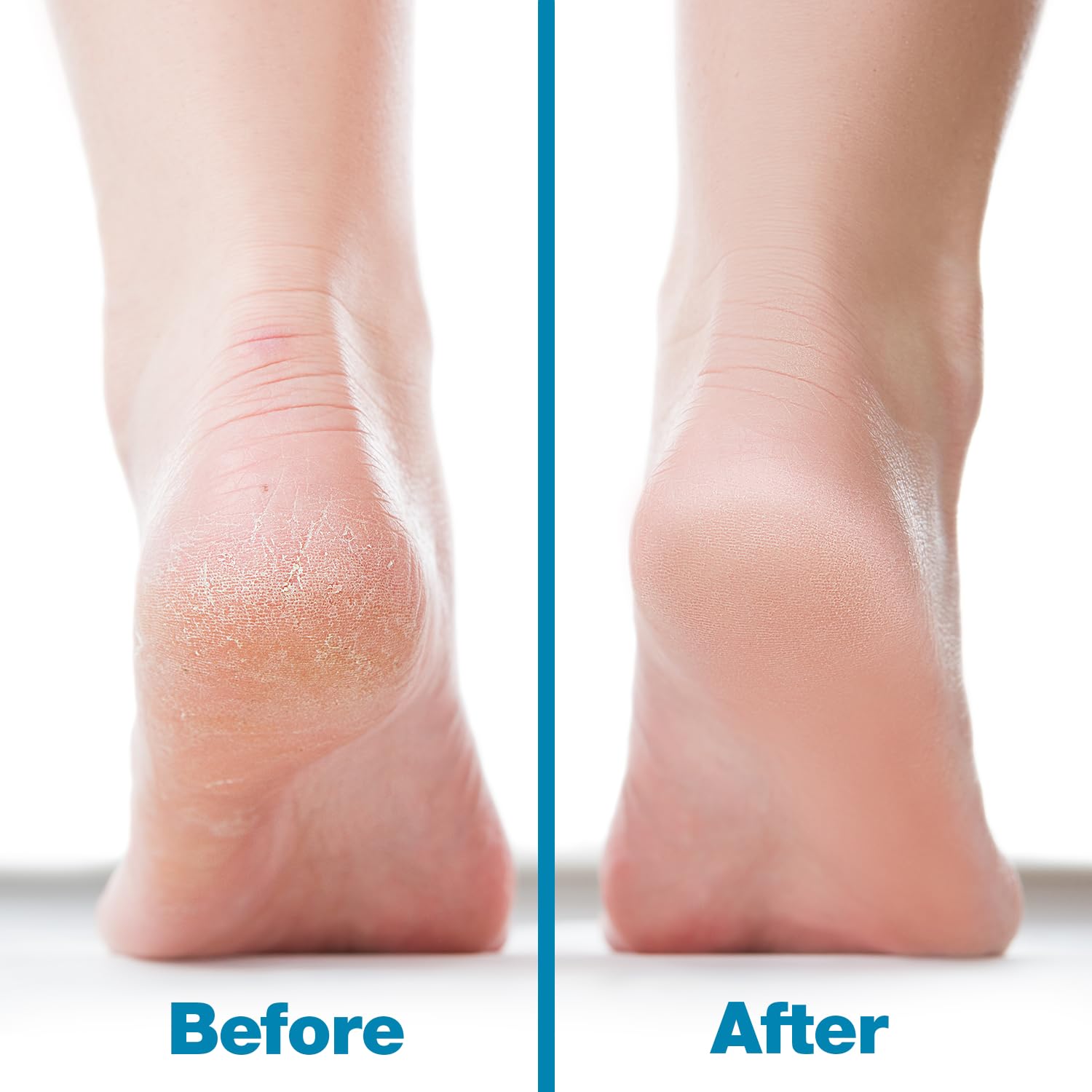 Probelle dry-foot use helps prepare feet quickly for gentle smoothing.