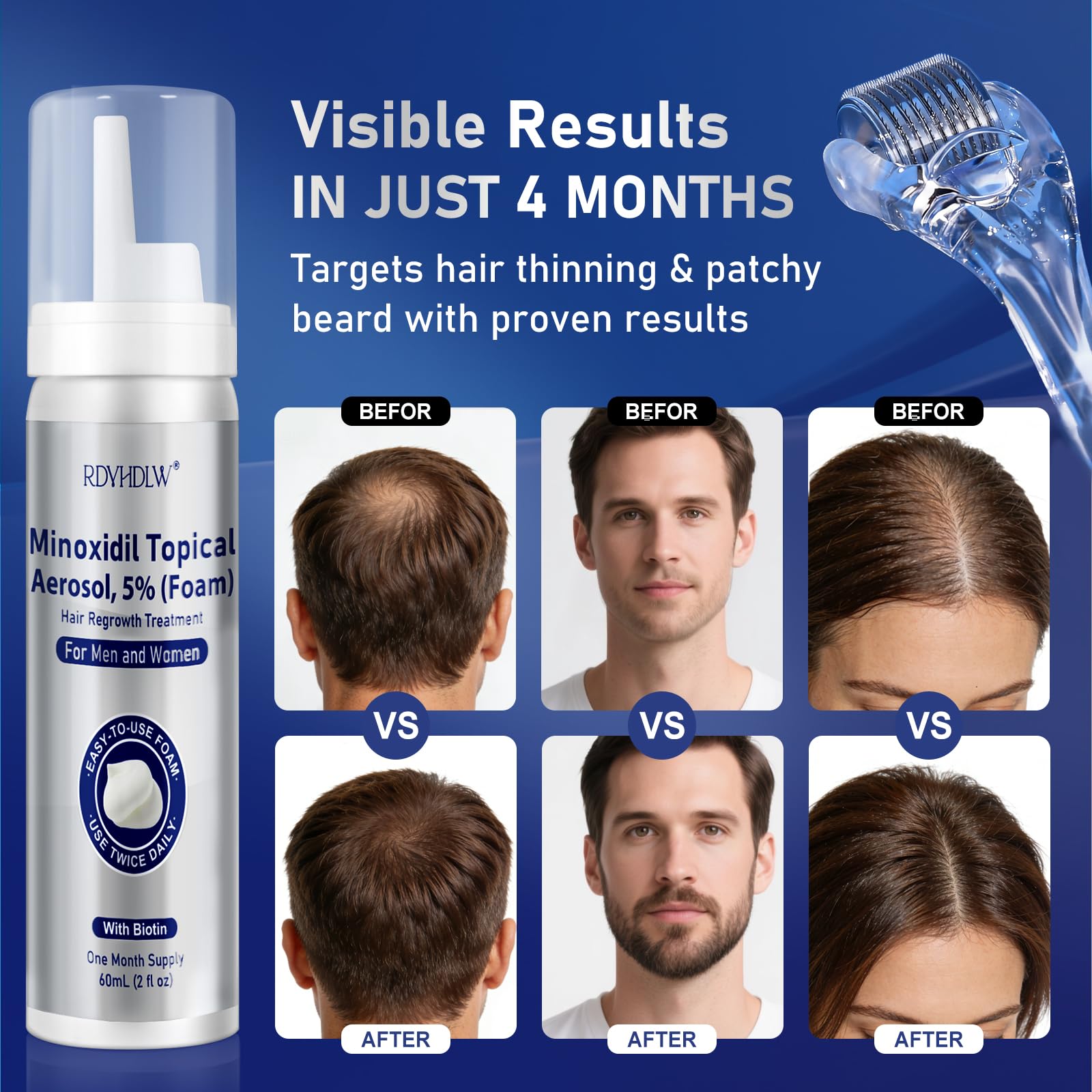 RDVHDLW minoxidil foam applied to scalp for potential fuller hair appearance