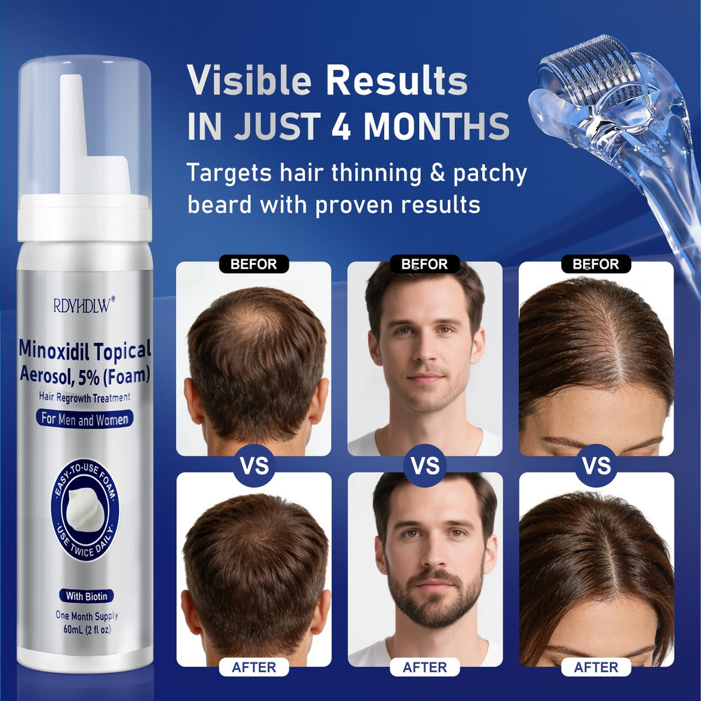 RDVHDLW minoxidil foam applied to scalp for potential fuller hair appearance
