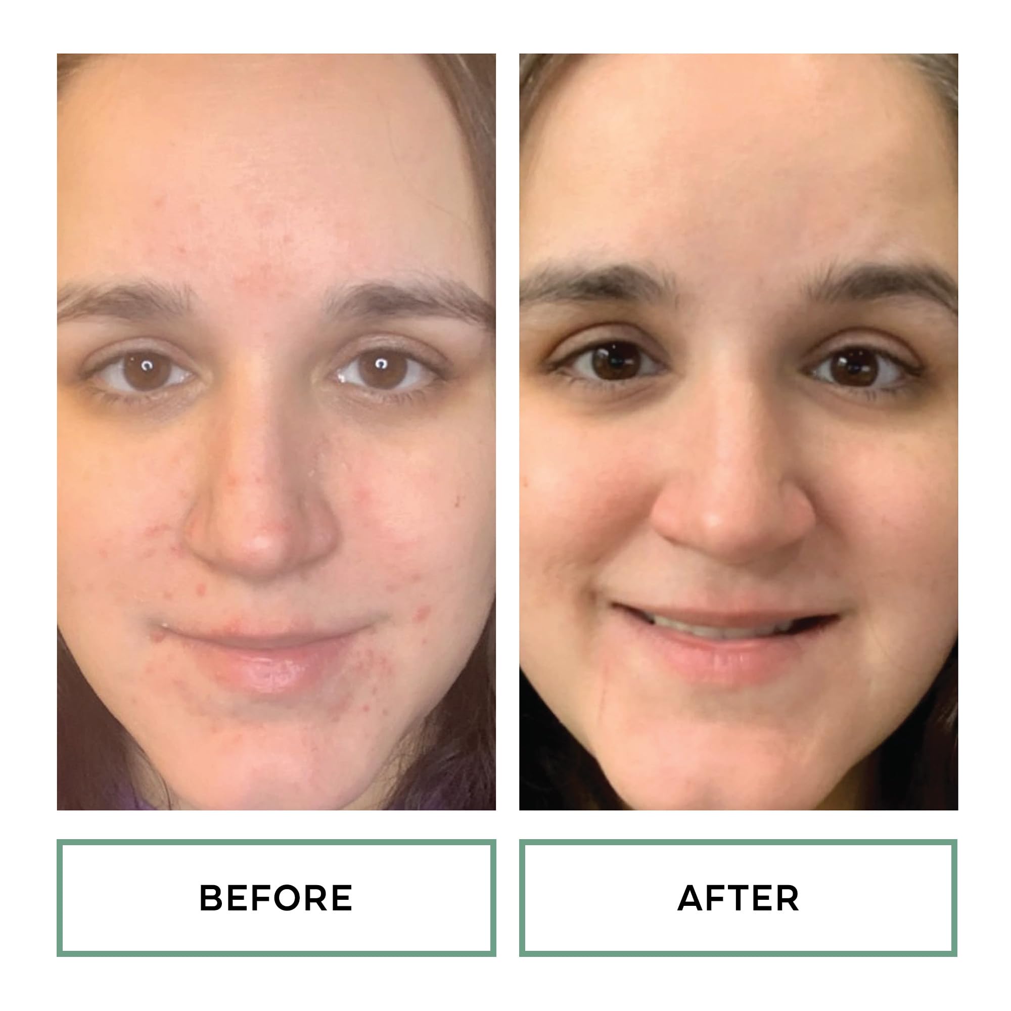 Gly-Sal pad used on face for cleansing and pore refinement.