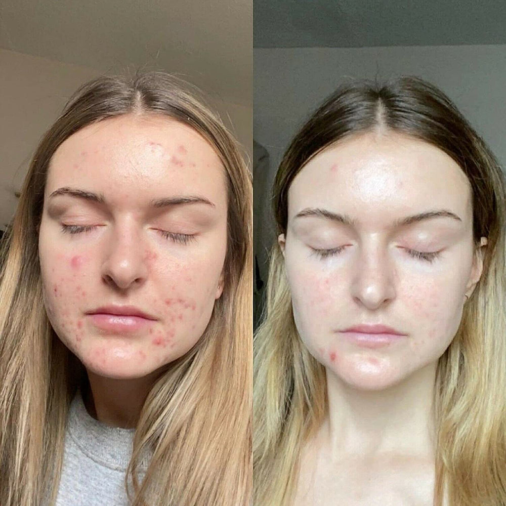 Retinol Gel 0.1% on hand ready for nightly application.
