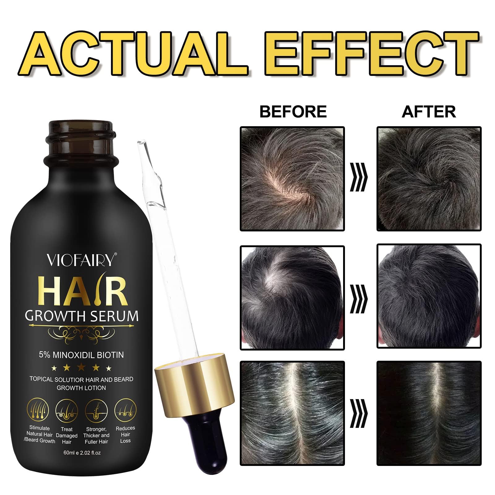 Aplicación diaria del suero minoxidil para estimular folículos capilares.