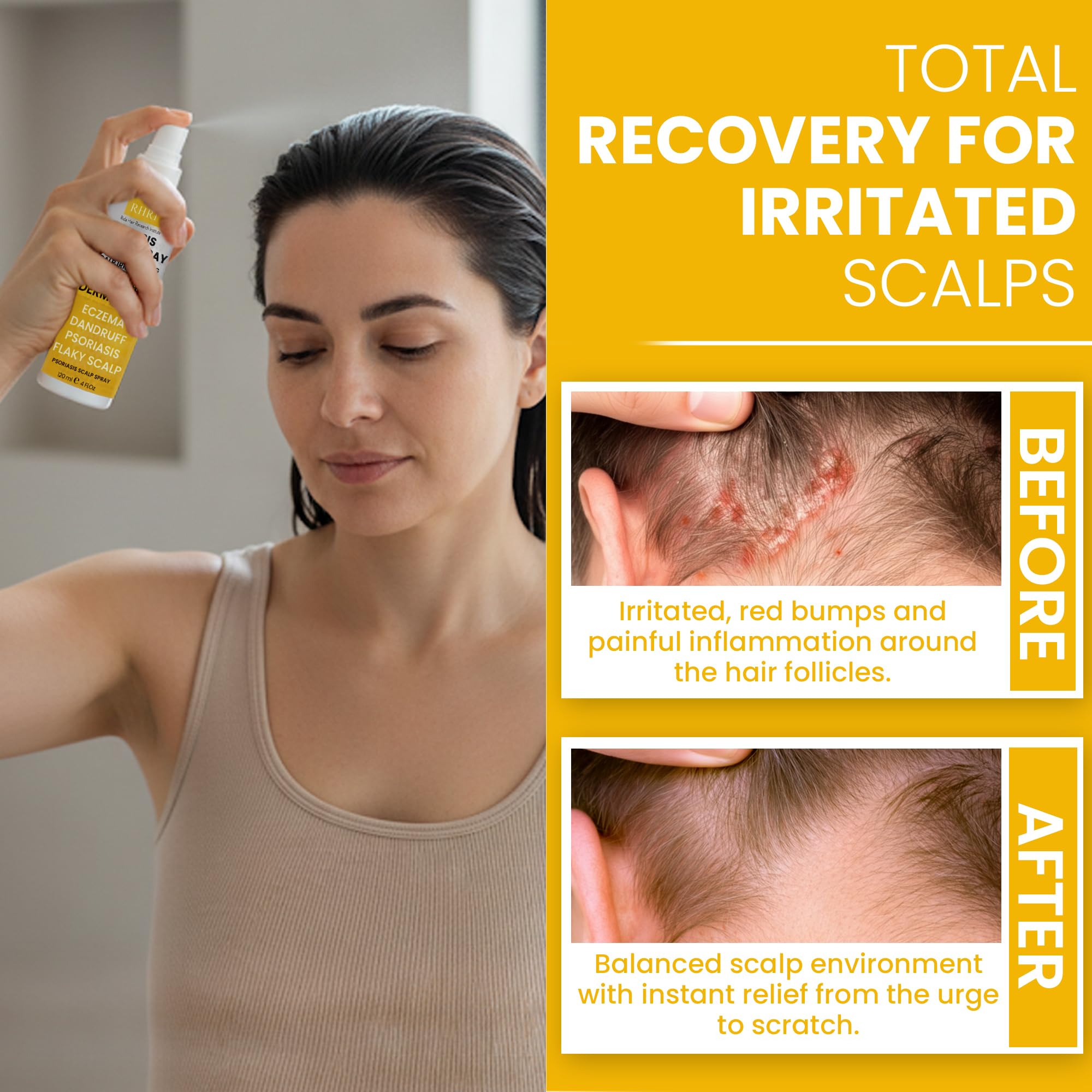 Rida Hair Psoriasis Scalp Spray application area on scalp demonstrates precision use