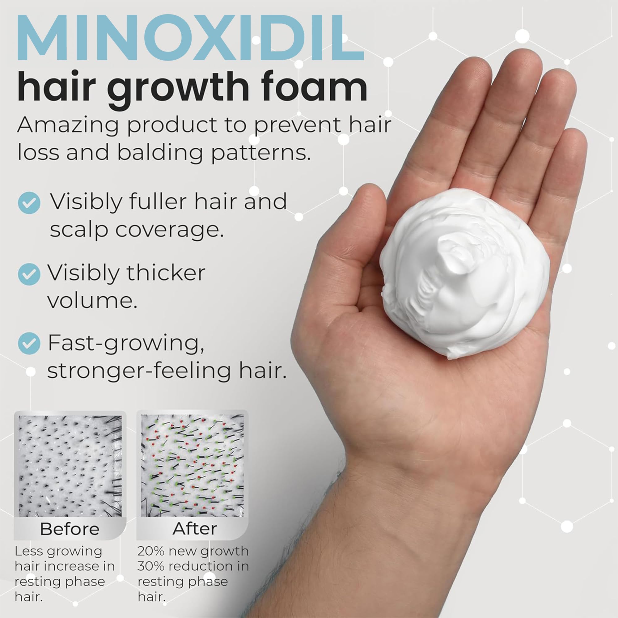 Rida Hair Remixidil foam massaged into the scalp for even coverage.