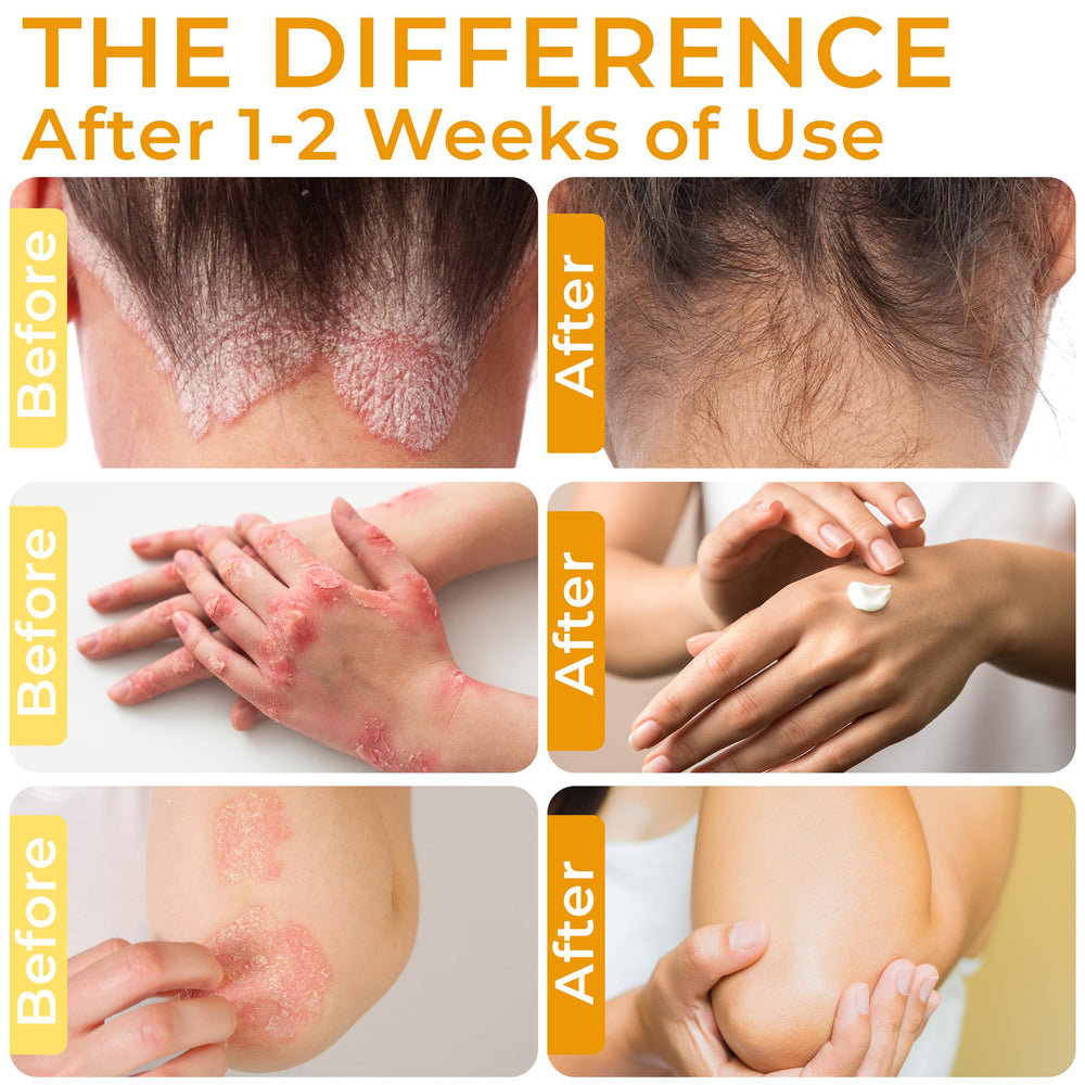 Rida Psoriasis Cream texture close-up showing gentle skin nourishment.