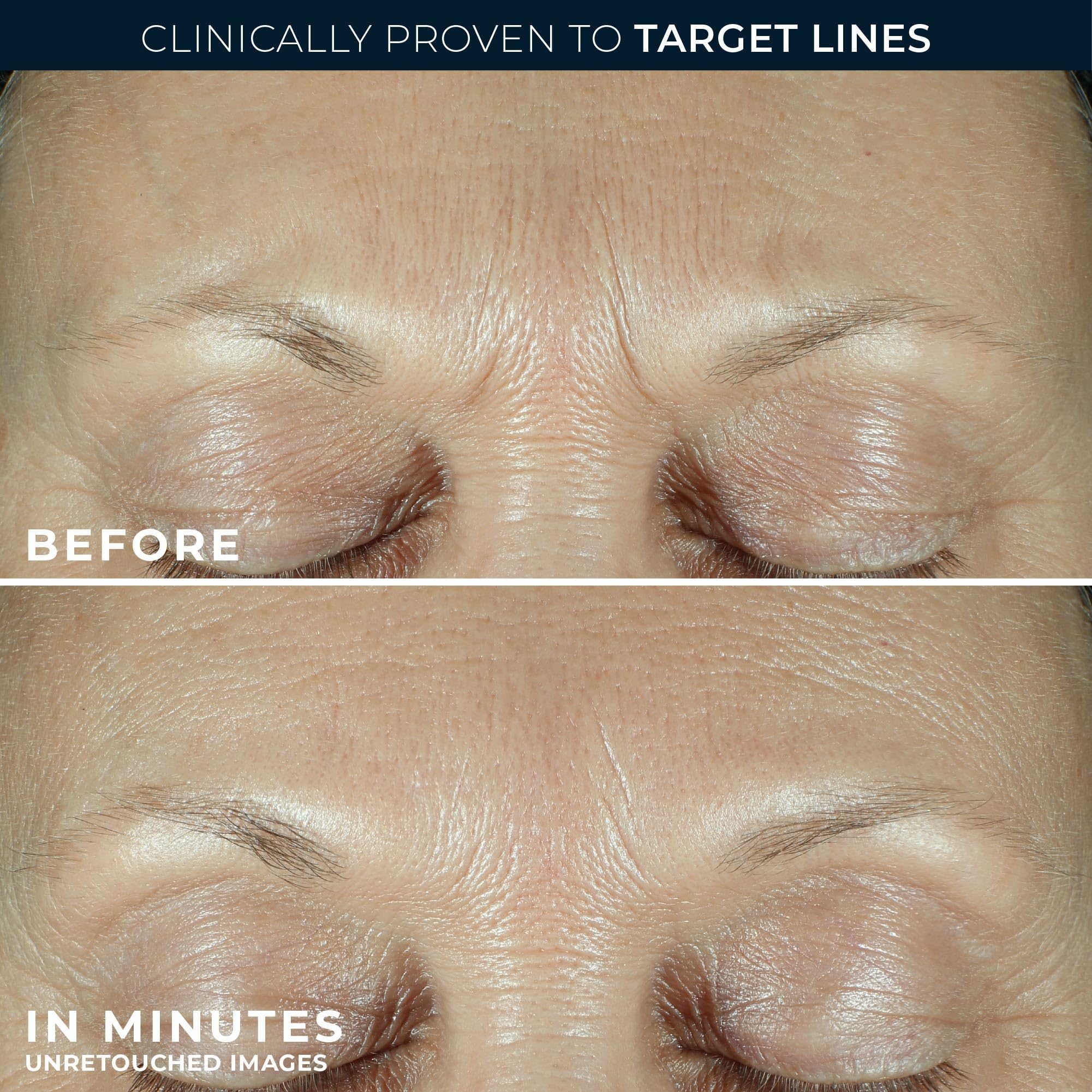RoC Derm Correxion serum bottle emphasizes triple hyaluronic acid hydration.