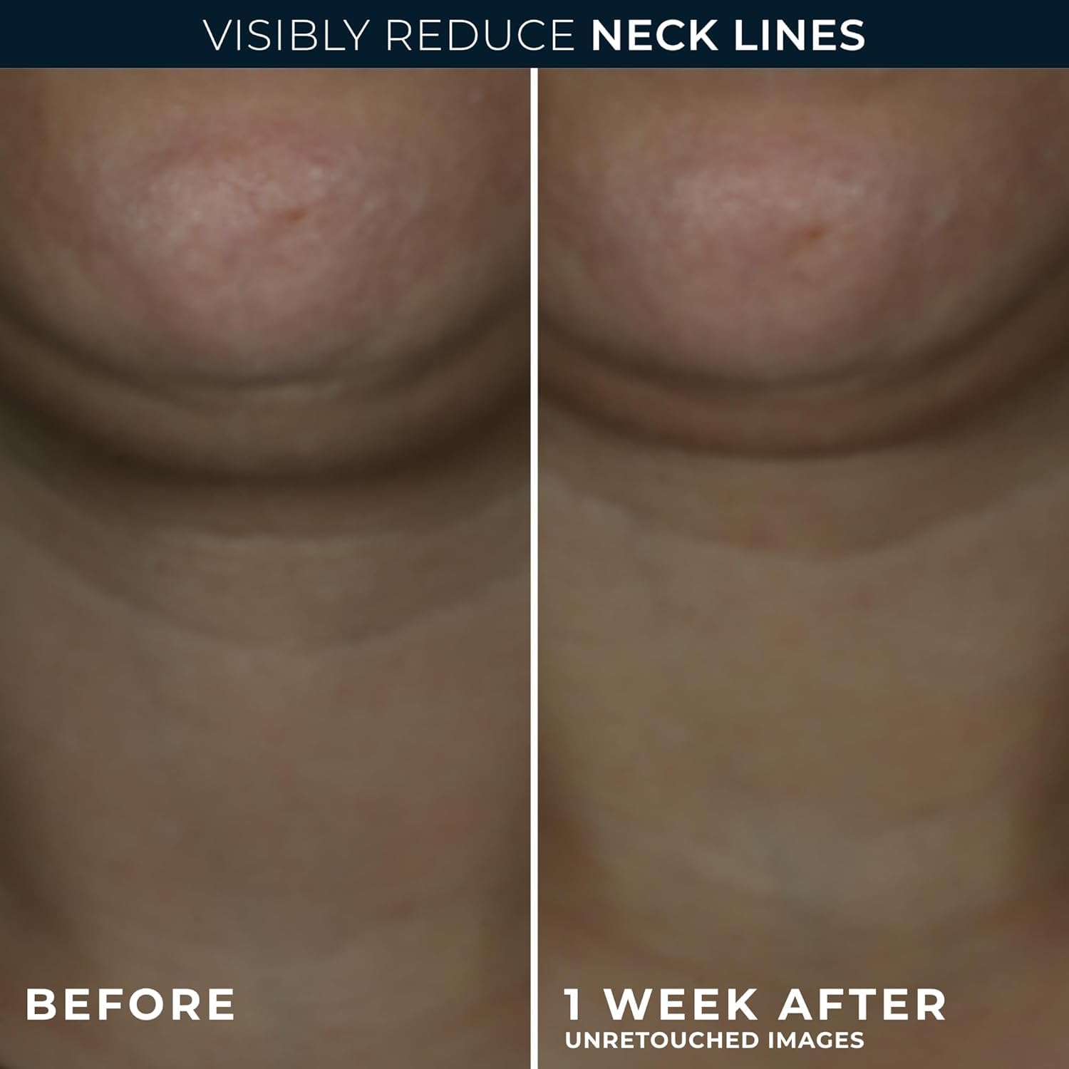 RoC neck cream with advanced retinol for firmer, lifted-looking skin.