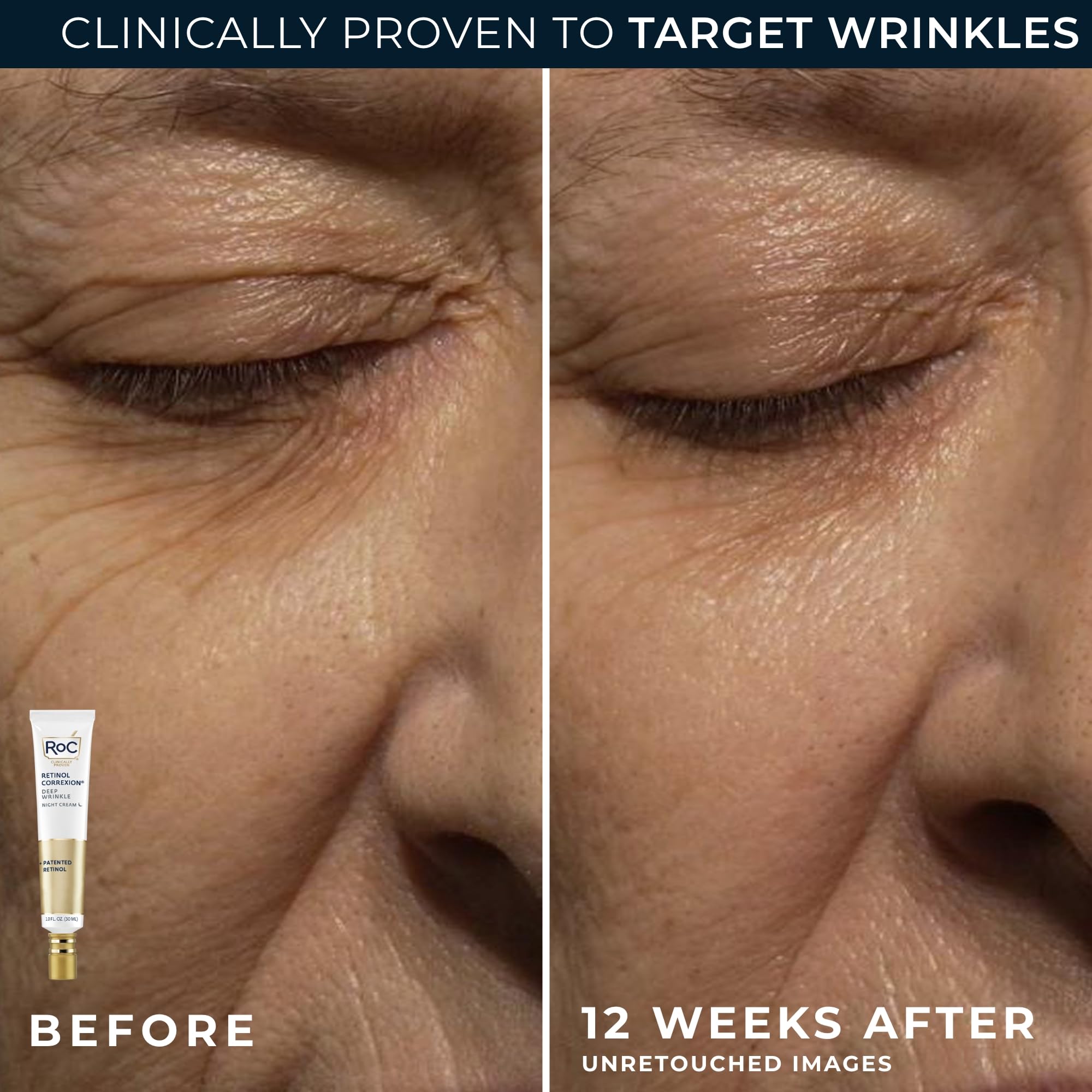 Eye cream application close-up for delicate eye-area care