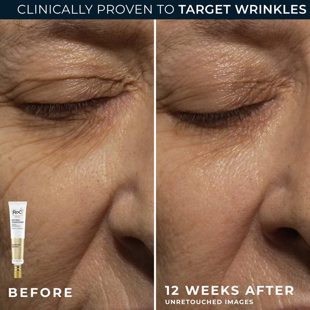 Eye cream application close-up for delicate eye-area care