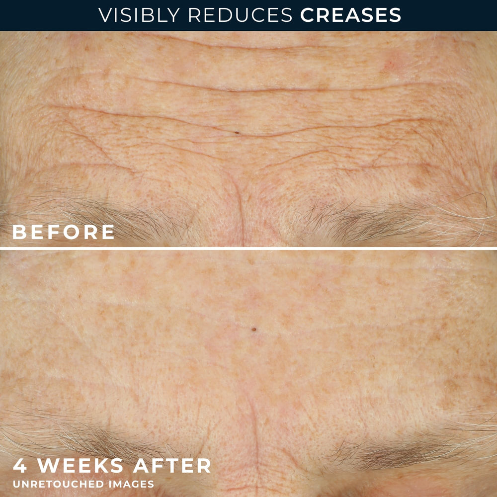 RoC Retinol Wrinkle Smoothing Capsules deliver targeted retinol for smoother texture.