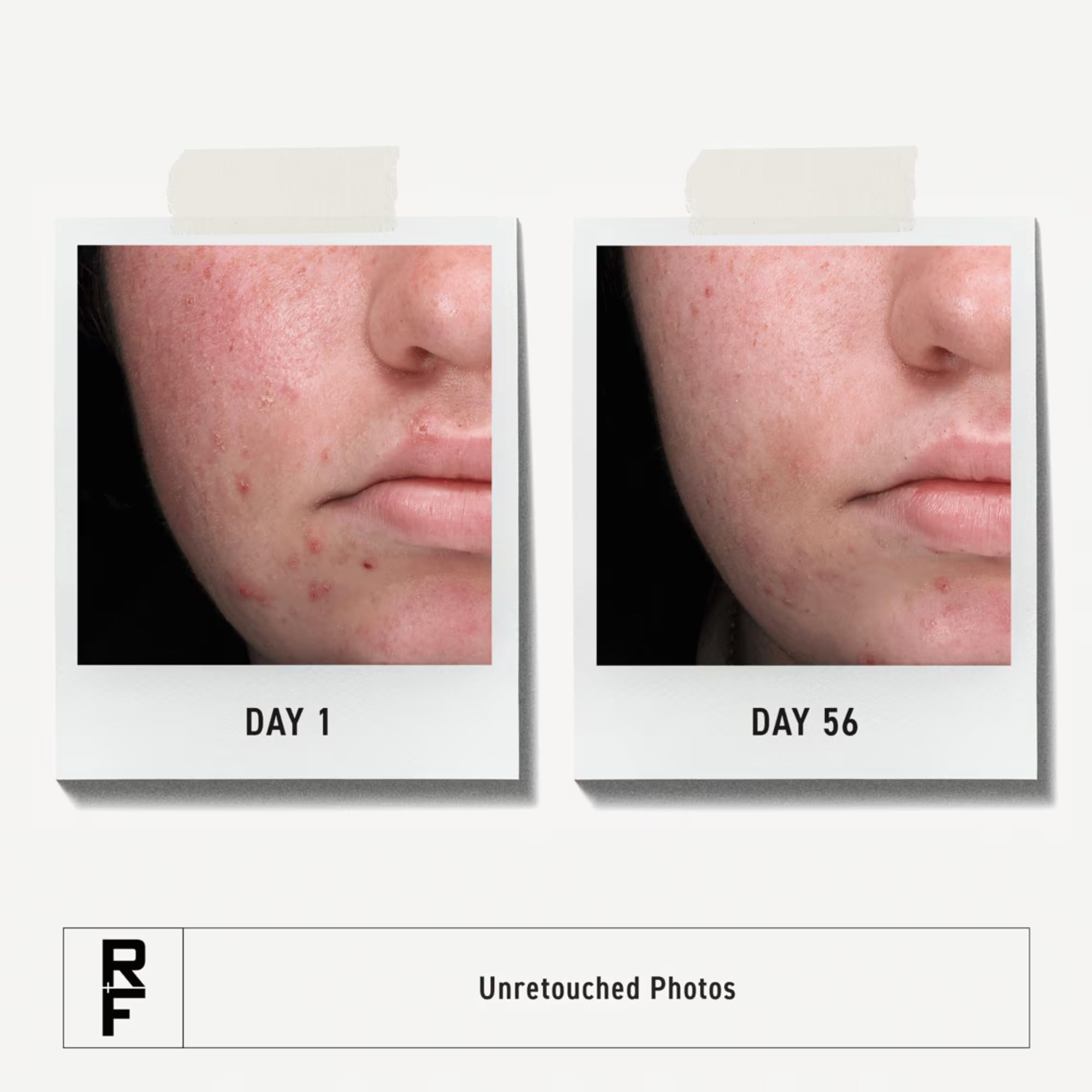 Rodan Fields Spotless Daily Acne Wash close-up, deep cleansing for pores