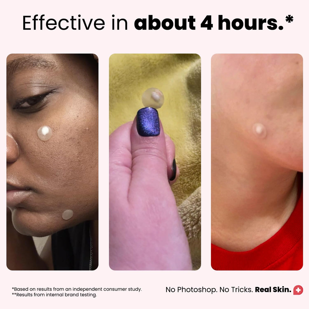 ROSELYNBOUTIQUE pimple patches in four sizes for a precise fit.
