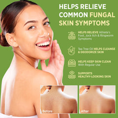 RoyceDerm Antifungal Bar Soap – face and body cleansing with 1% clotrimazole.