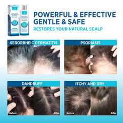 Roycederm duo-packaged on counter showcases complete scalp care set.