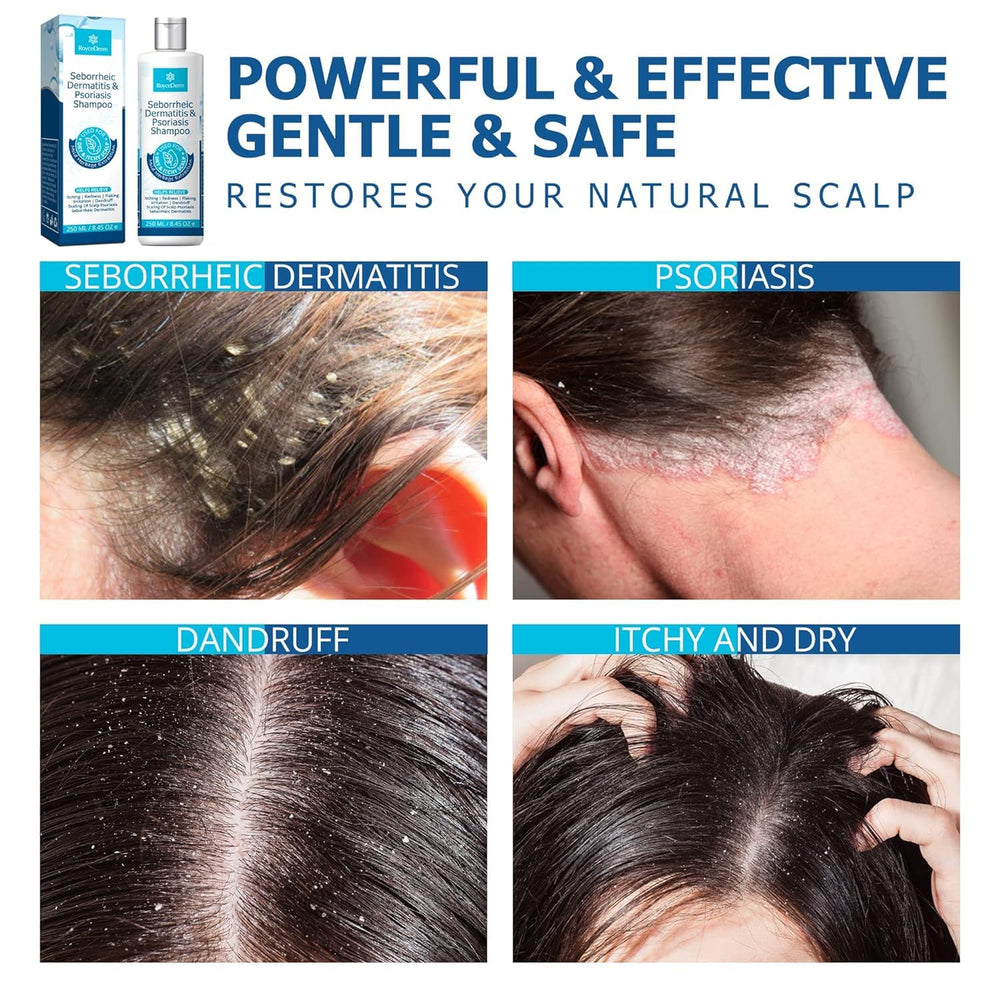 Roycederm scalp care routine visual emphasizing daily use and relief potential.
