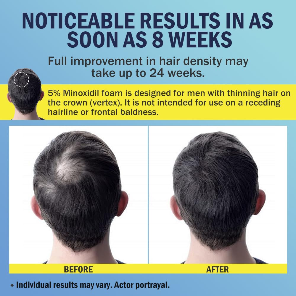 Ruahouine Minoxidil espuma aplicación cabello: promueve cobertura uniforme.