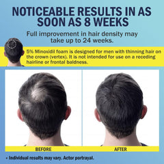 Ruahouine Minoxidil espuma aplicación cabello: promueve cobertura uniforme.