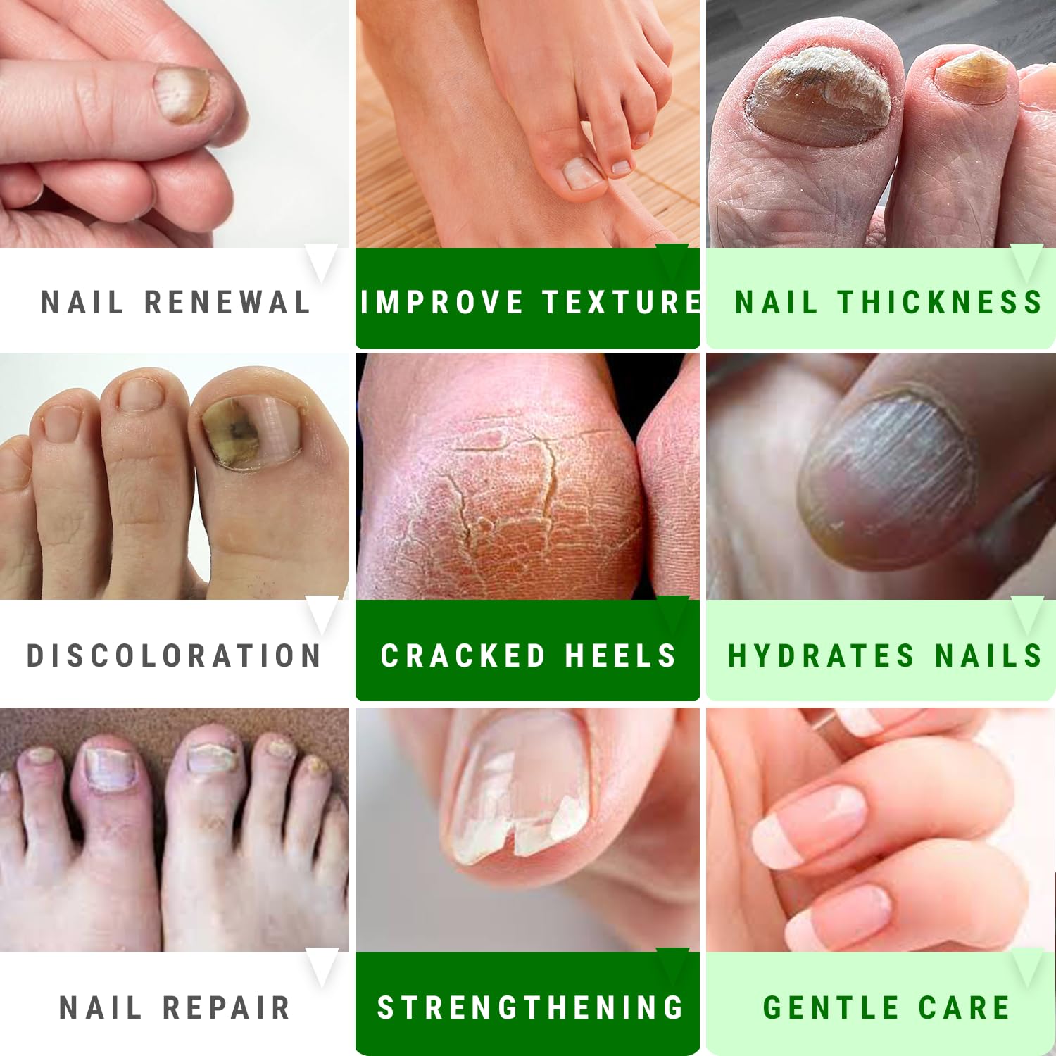 Scientific Solutions Global Urea Nail Gel on fingernails for smooth appearance.