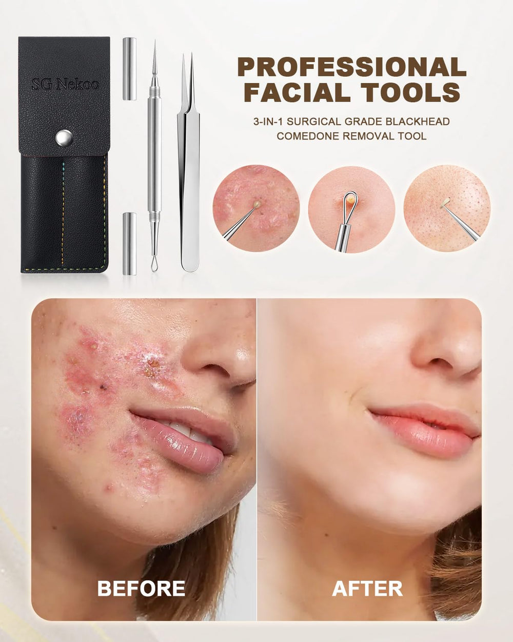 SG Nekoo needle with sharp tip enables targeted blemish removal.