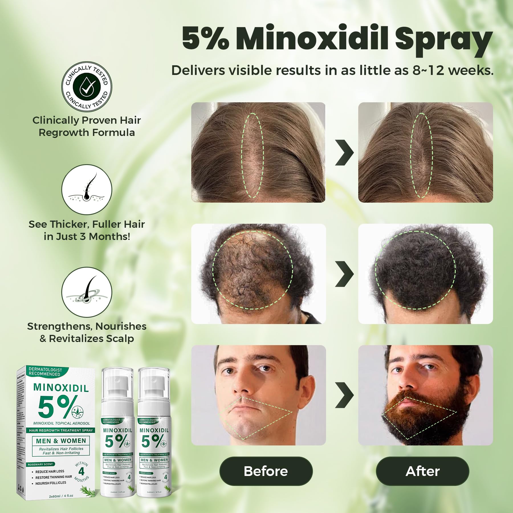 SHIUMORE minoxidil rosemary spray close-up shows quick-absorbing non-greasy formula.