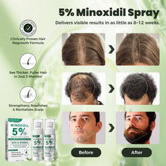 SHIUMORE minoxidil rosemary spray close-up shows quick-absorbing non-greasy formula.