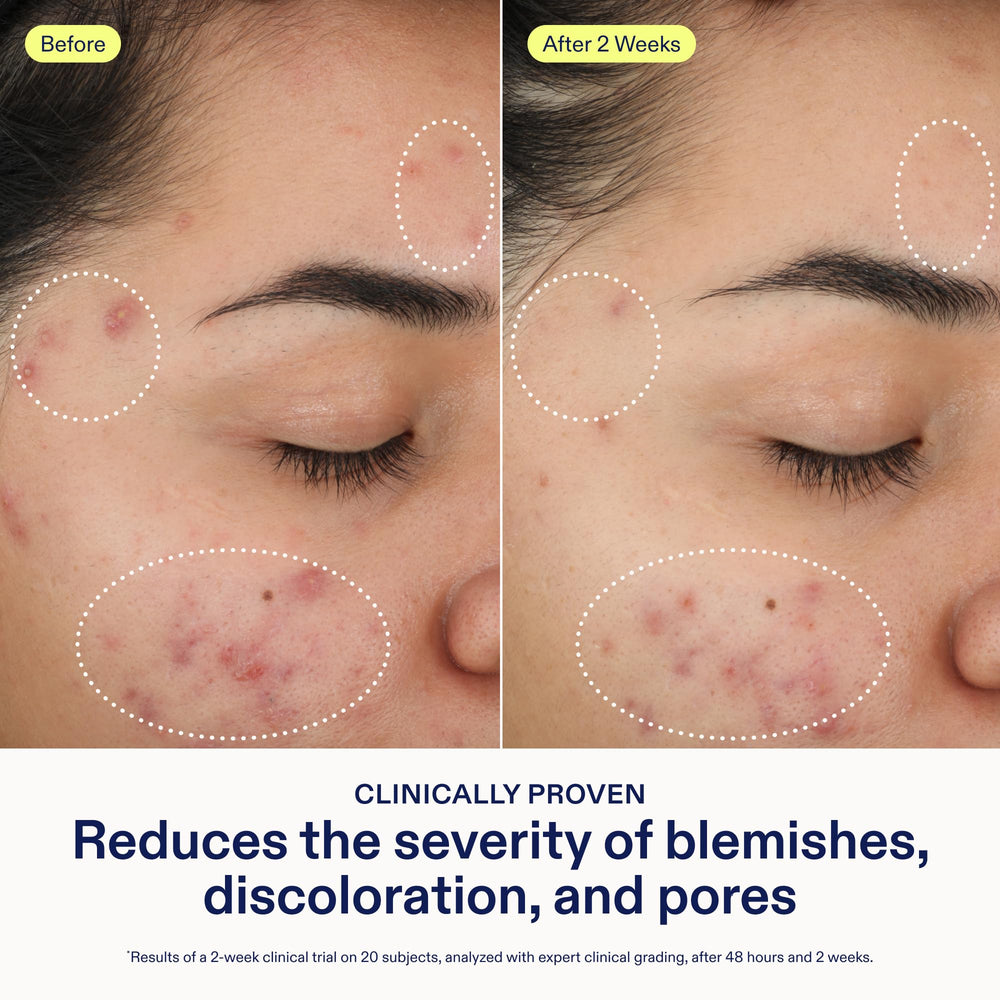 Skinfix 2% BHA Cleanser application on face to target oily areas.
