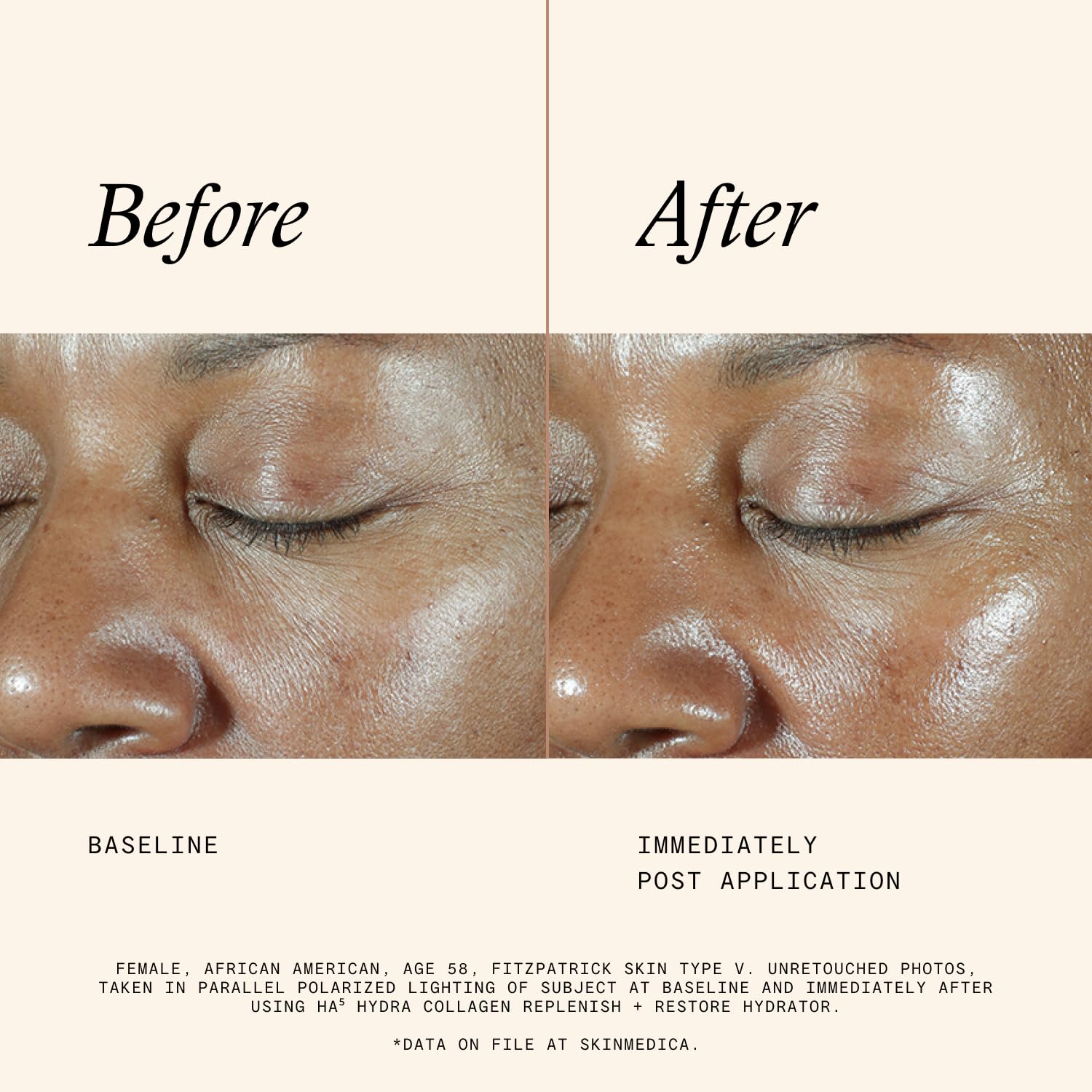 SkinMedica HA5 avocado oil esters highlight nourishing touch.