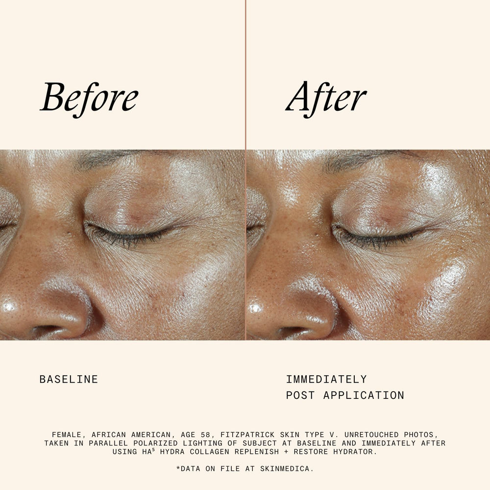 SkinMedica HA5 avocado oil esters highlight nourishing touch.