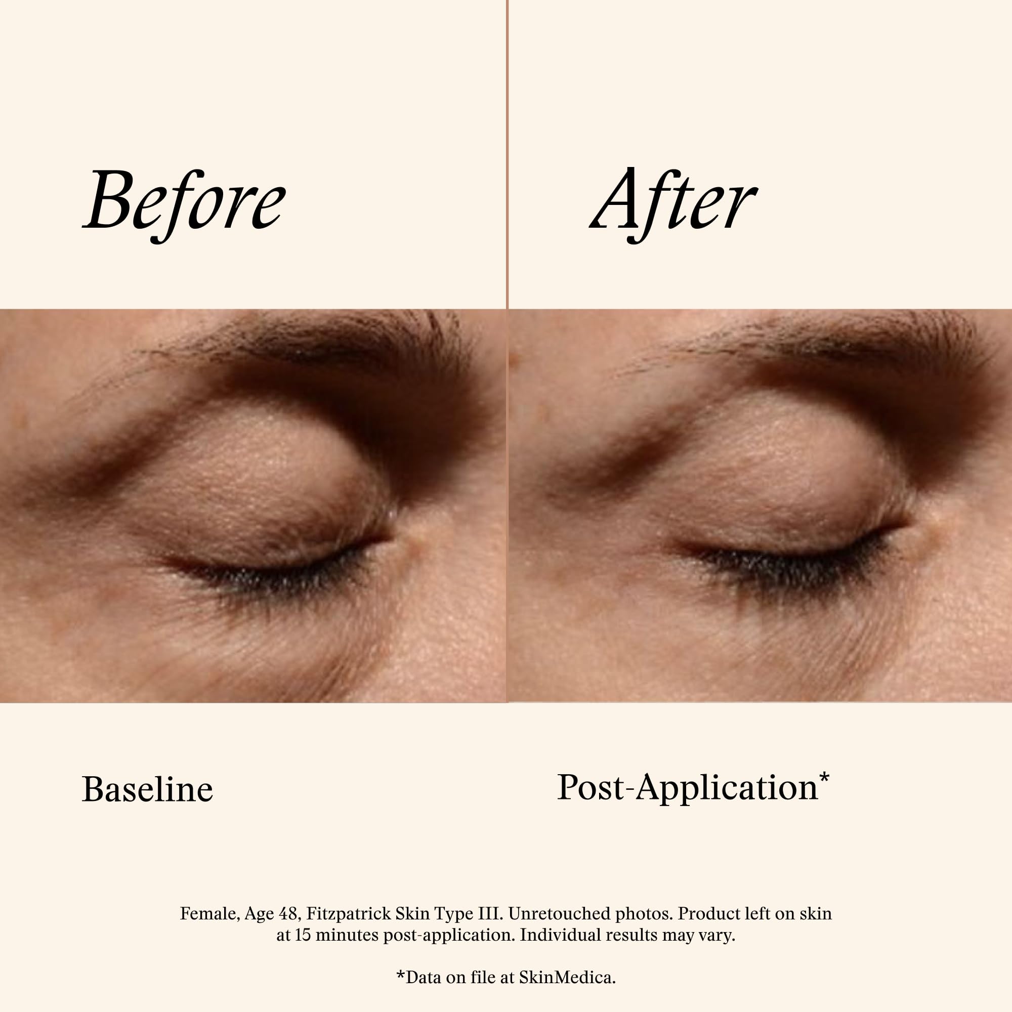 Dabbing SkinMedica eye cream on under-eye area for a refreshed look