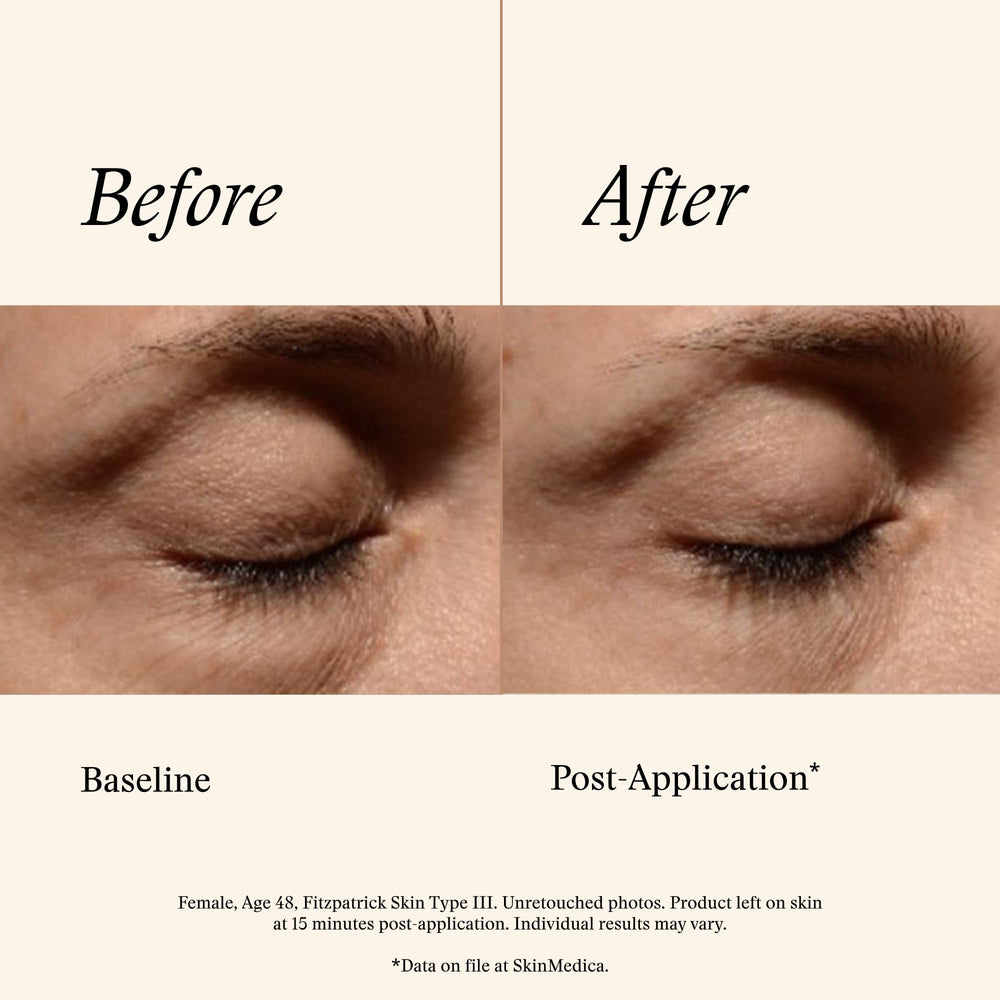 Dabbing SkinMedica eye cream on under-eye area for a refreshed look