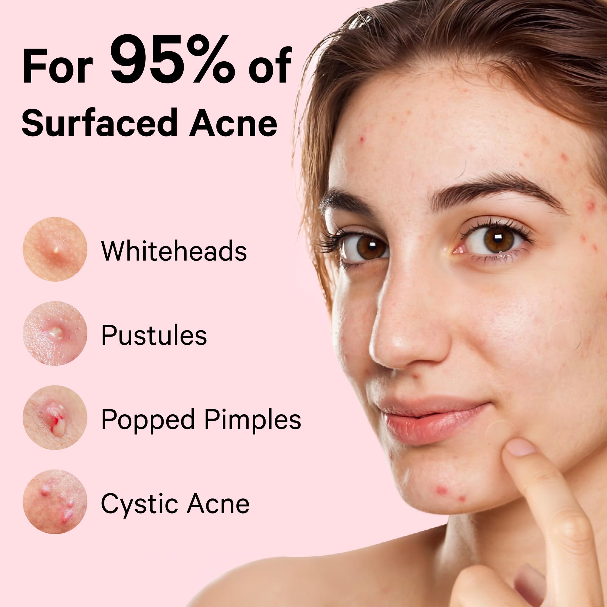 Sosky patches ideal for on-the-go acne spot treatment