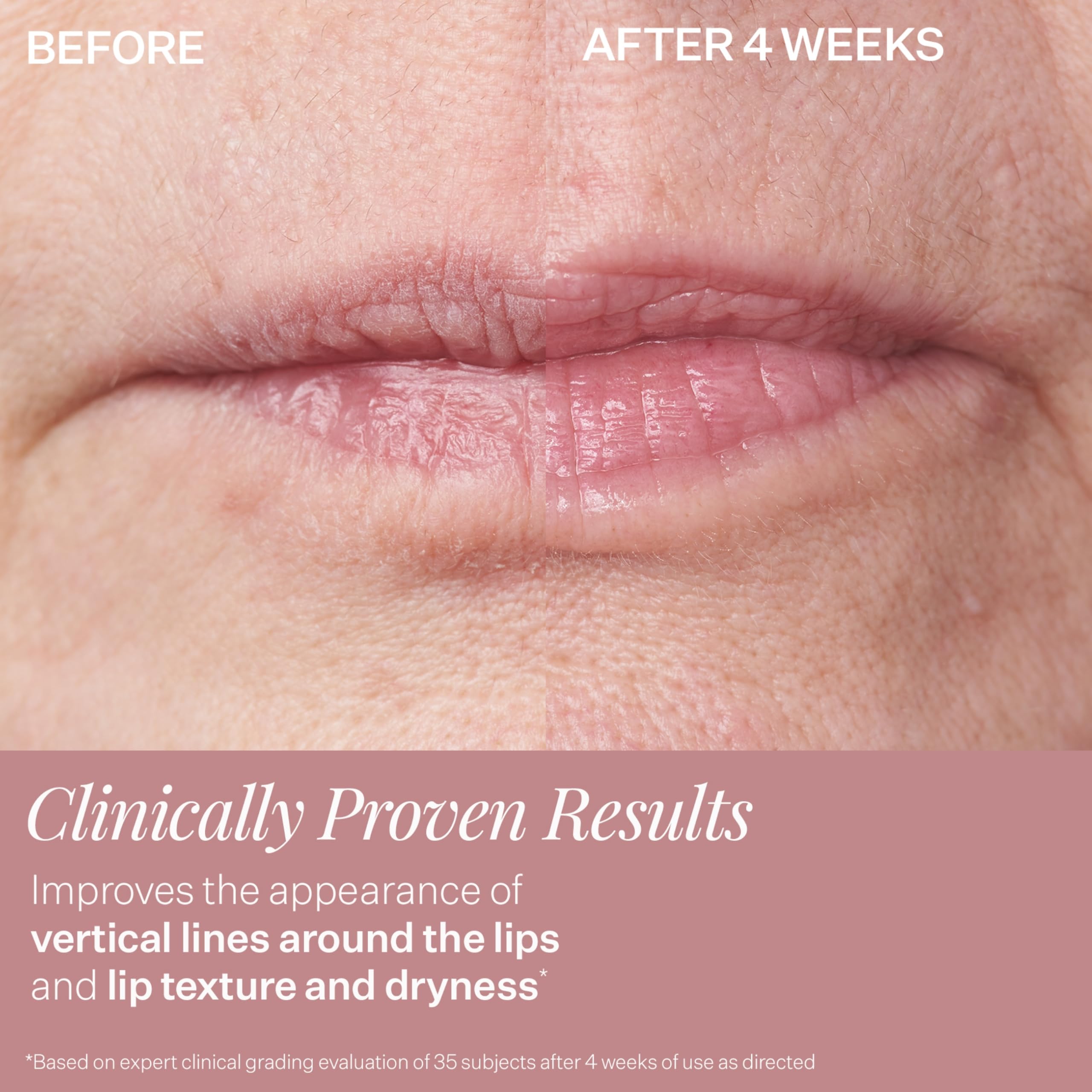 StriVectin DoubleFix before-after lip line comparison