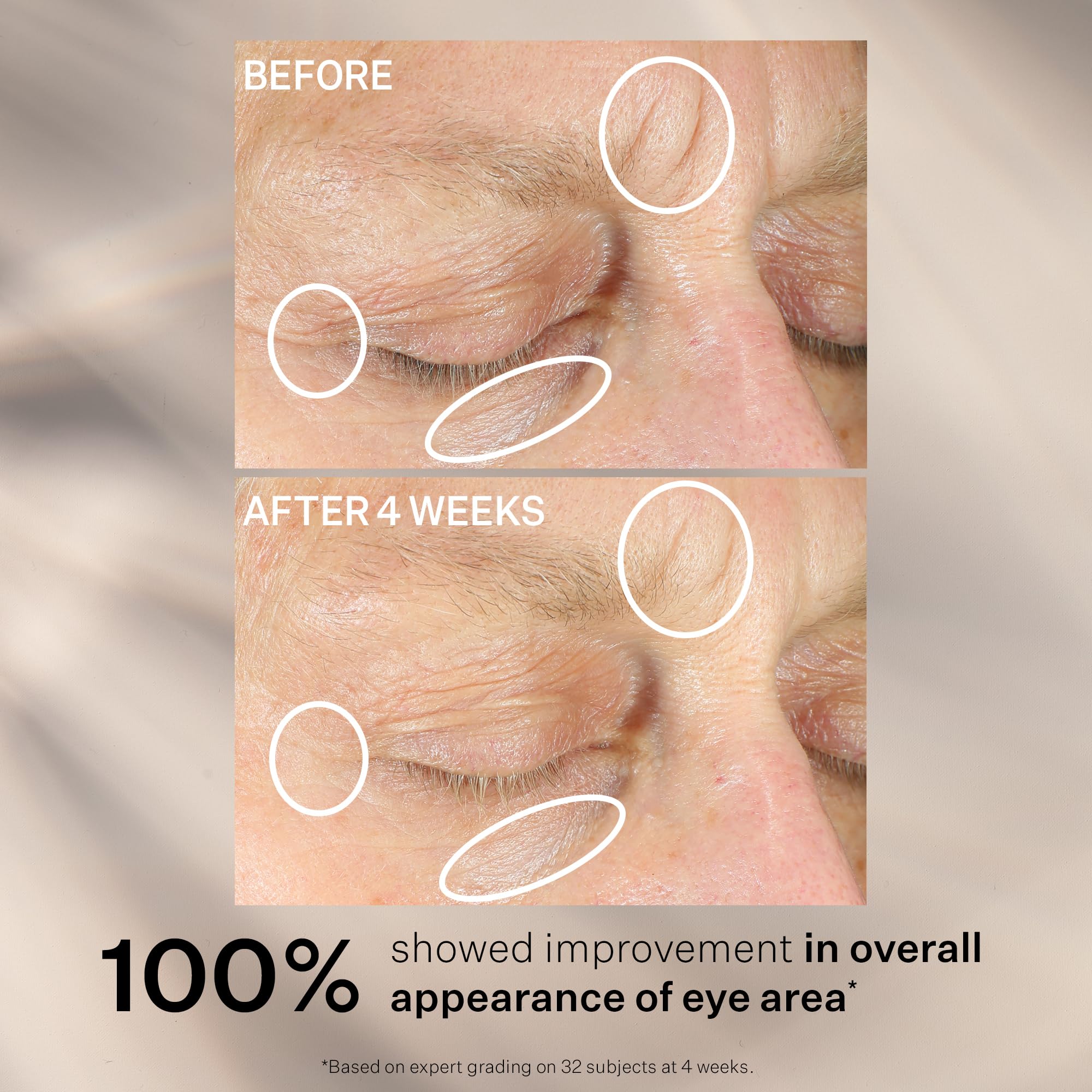 Eye area close-up showing reduced dark circles and lines with StriVectin cream