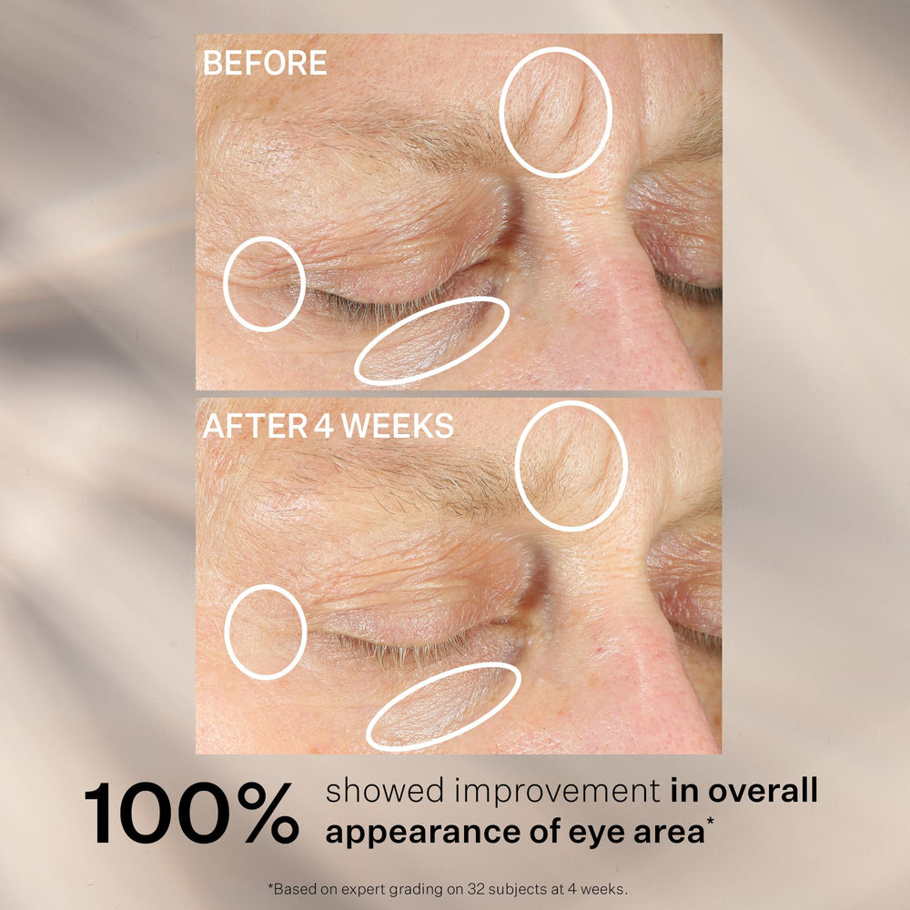 Eye area close-up showing reduced dark circles and lines with StriVectin cream