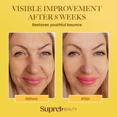 SupreH Bee Venom Cream around the eyes showcases tightening potential