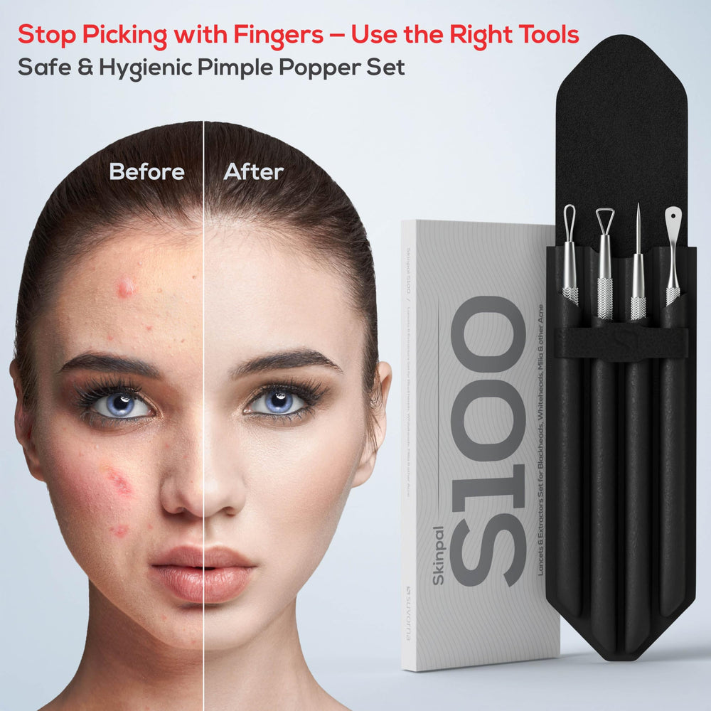 Suvorna whitehead remover tool for blemish and cyst assistance