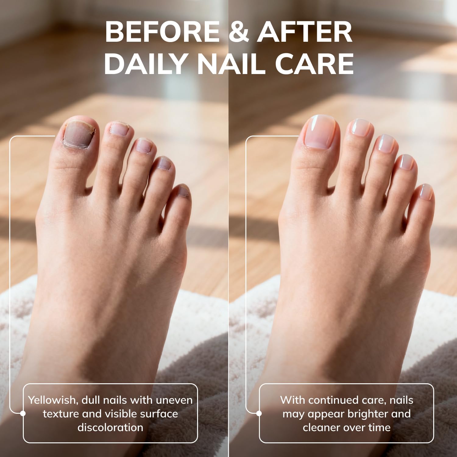 Nails during treatment displaying gradual nourishing effect from Swissklip KlearNail
