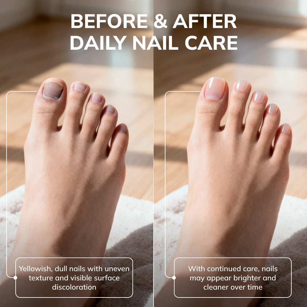Nails during treatment displaying gradual nourishing effect from Swissklip KlearNail