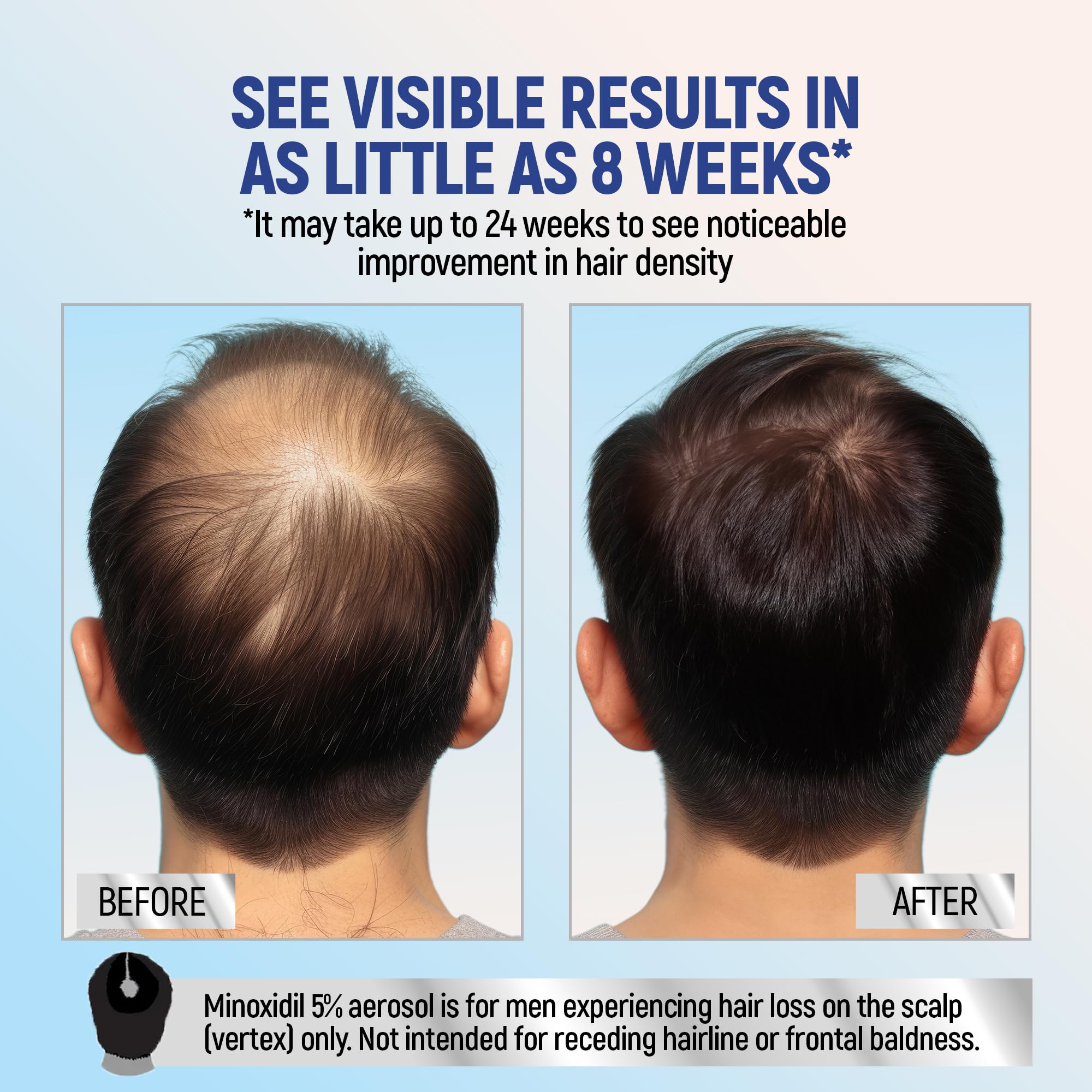 TARO Minoxidil foam on scalp application demonstrates precise scalp coverage