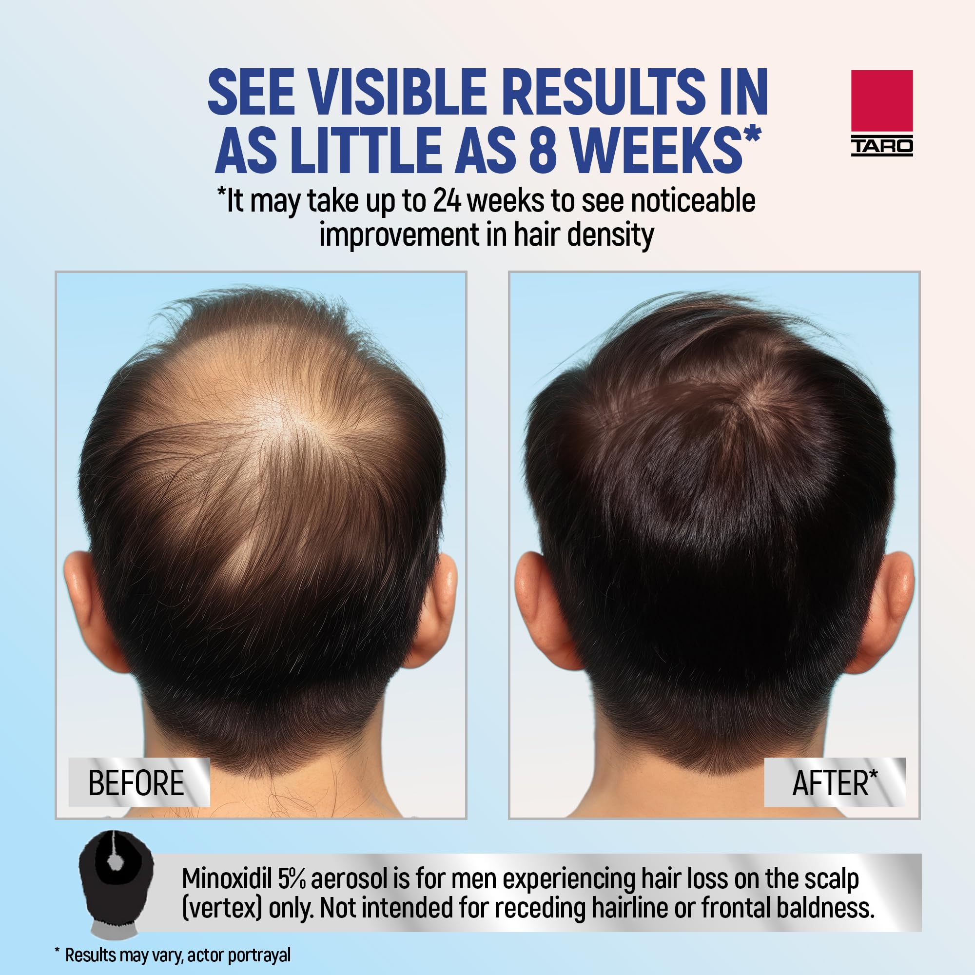 TARO Minoxidil foam product shot highlights compact, ready-to-use design.
