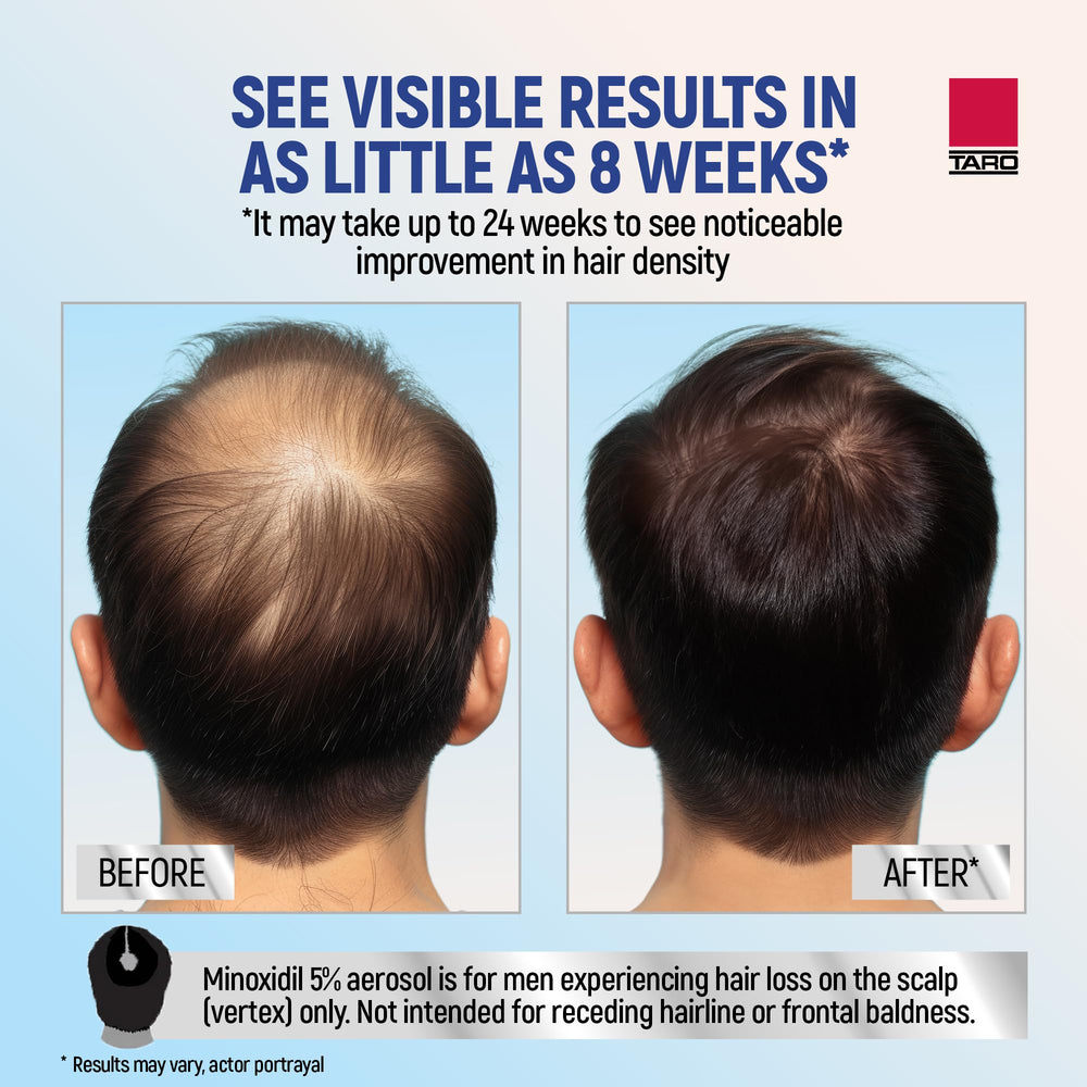 TARO Minoxidil para hombres: mayor densidad capilar con uso continuo