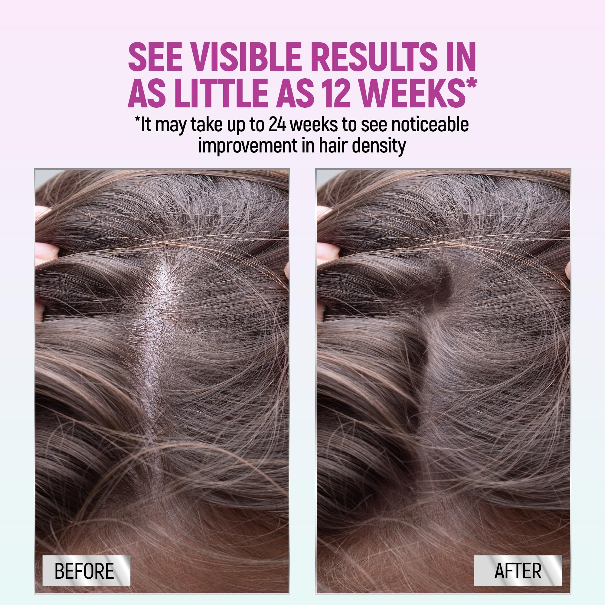TARO Minoxidil para mujer ayuda a regenerar folículos y estimular crecimiento